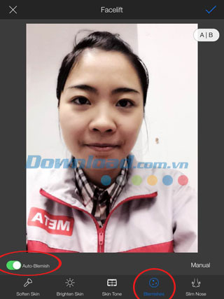 Xóa vết thâm nám